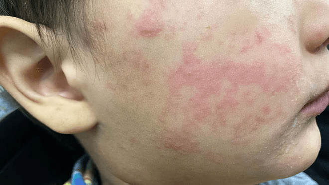 photo of measles rash from CDC